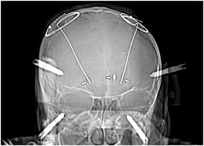 Case Report: Bilateral Deep Brain Stimulation Implantation on Different Targets for a Parkinson's Disease Patient With a Bullet in the Brain
